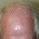 Antes de un trasplante capilar