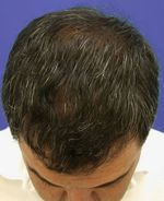 Después de un trasplante capilar