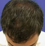 After Hair Transplant