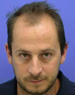 Antes de un trasplante capilar