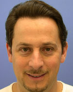 Después de un trasplante capilar