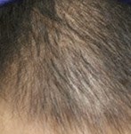 Antes PRP