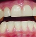 Antes de un blanqueamiento dental