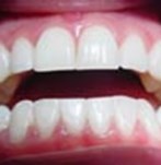 Después de un blanqueamiento dental