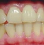 Antes de un blanqueamiento dental
