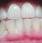 Después de un blanqueamiento dental