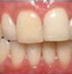 Antes de un blanqueamiento dental