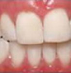 Después de un blanqueamiento dental