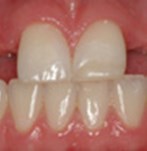 Antes de unos implantes dentales