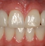 Después de unos implantes dentales