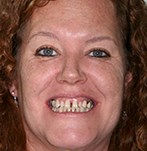 Antes de unos implantes dentales