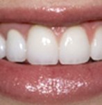 Después de unas coronas dentales