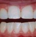 Después de unas coronas dentales