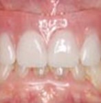 Después de una colocación de prótesis dentales fijas