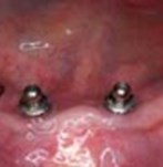 Antes de una colocación de una prótesis dental fija