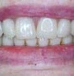 Después de una colocación de una prótesis dental fija