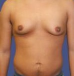 Antes de una reducción de pecho para hombre