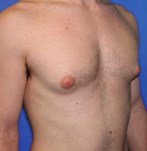 Before Gynecomastia