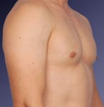 After Male Breast Reduction