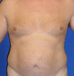 Antes de una lipoescultura