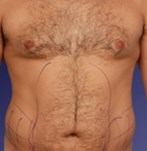 Before Male Liposculpture