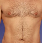 After Male Liposculpture