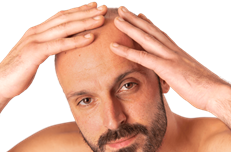 Trasplante capilar