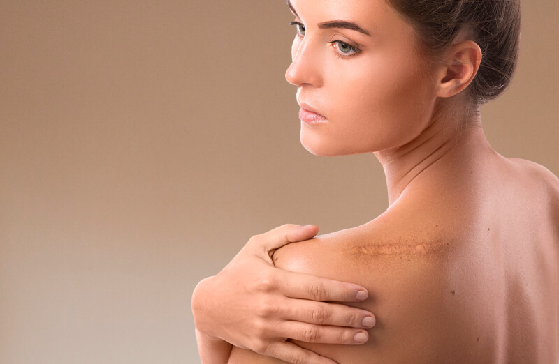 Corrección de cicatrices