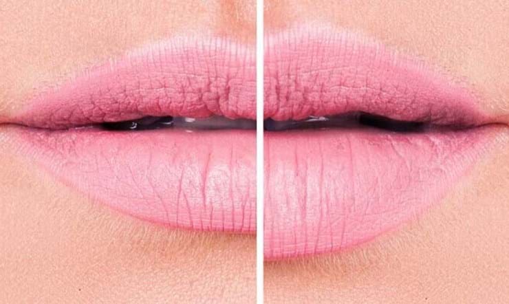 Las 4 cosas que debes saber sobre el relleno de labios