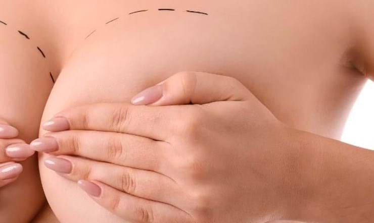 ¿Cuándo se deben cambiar los implantes mamarios?
