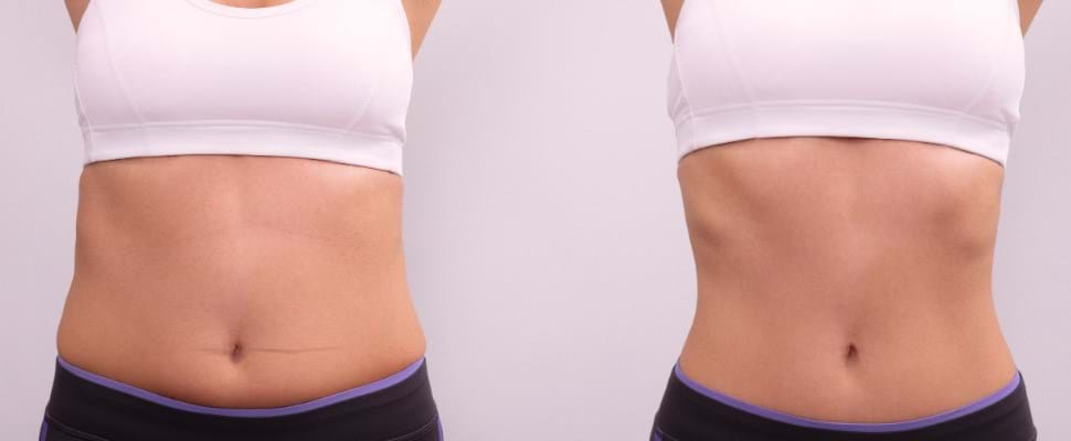 ¿Qué partes del cuerpo se pueden tratar con liposucción?