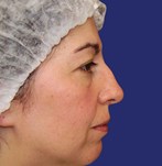 Foto de perfil antes de la rinoplastia, nariz con desviación visible