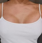 Breast augmentation operation with size 340cc XP implants