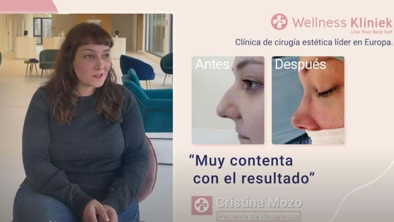 Testimonio sobre Rinoplastia en Wellness Kliniek Barcelona