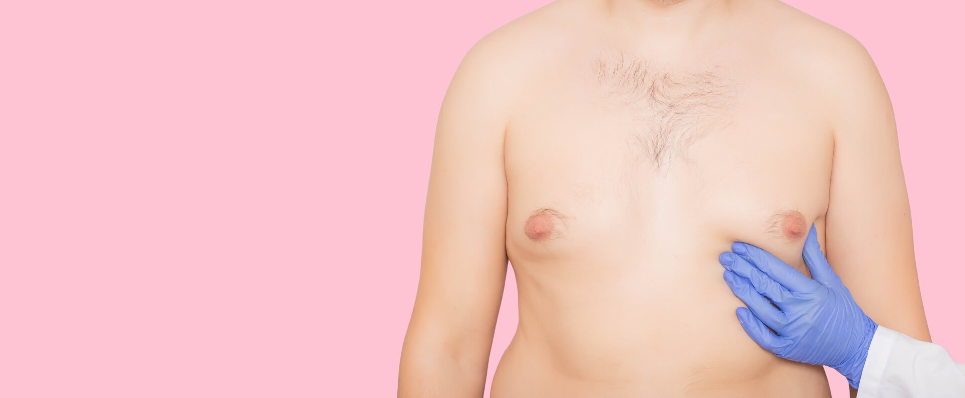¿Cómo saber si tengo ginecomastia?