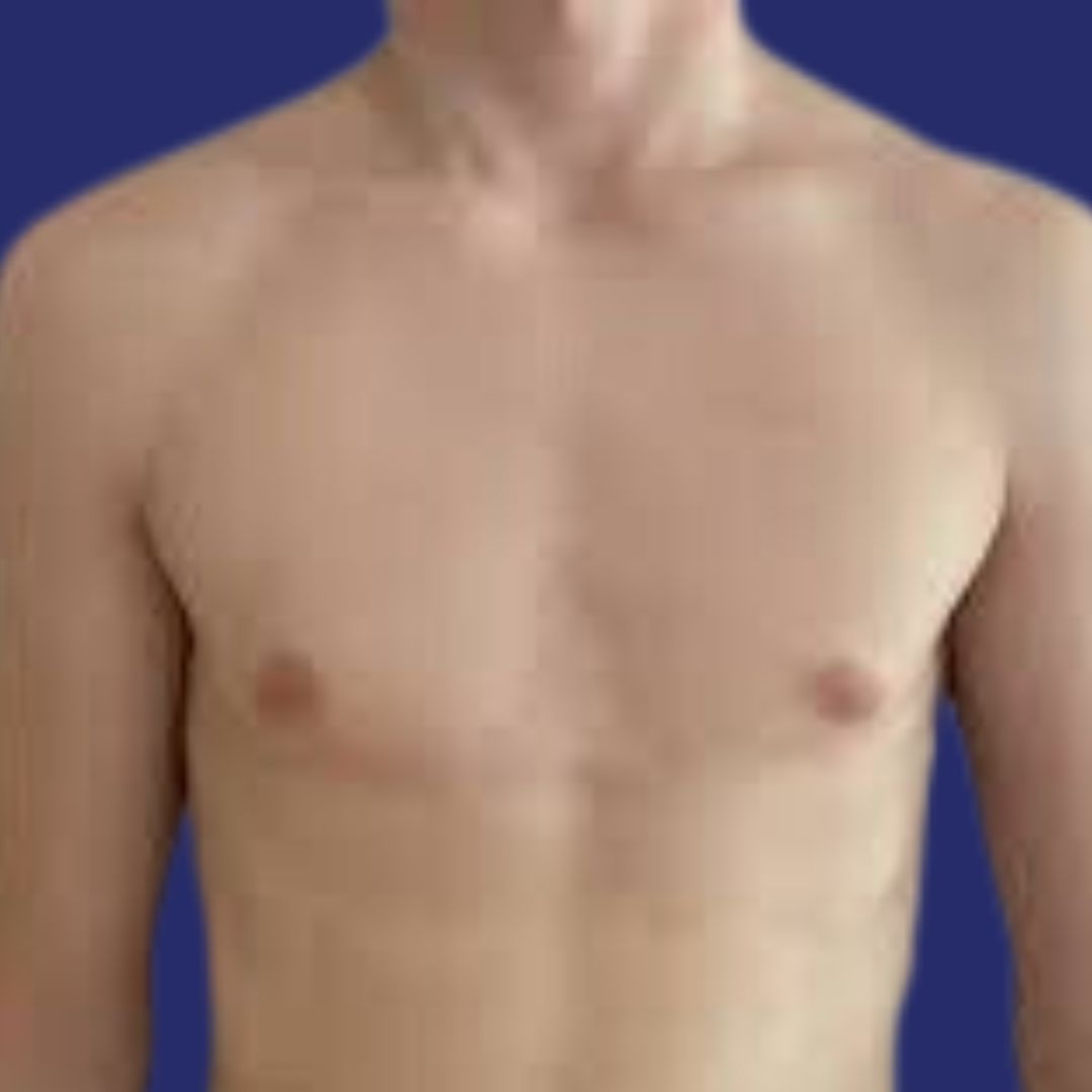 Antes aumento de pecho transgénero