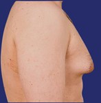 Exceso de tejido mamario hombre - antes  
