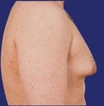 Excess breast tissue male