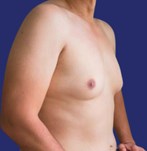 before  After Gynecomastia Surgery 