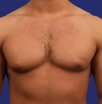 Male Breast before gynecomastia surgery