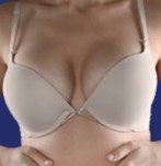 Reemplazo de implantes mamarios de 480cc a 300cc