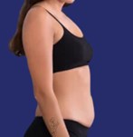 Imagen previa al procedimiento de liposucción