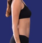 imagen después de un procedimiento de liposucción