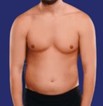 Image of the area to be treated before the liposuction procedure.