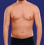 Image of the treated area after the liposuction procedure.
