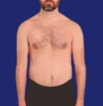 liposuction for men before and before picture