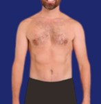 liposuction for men before and after picture