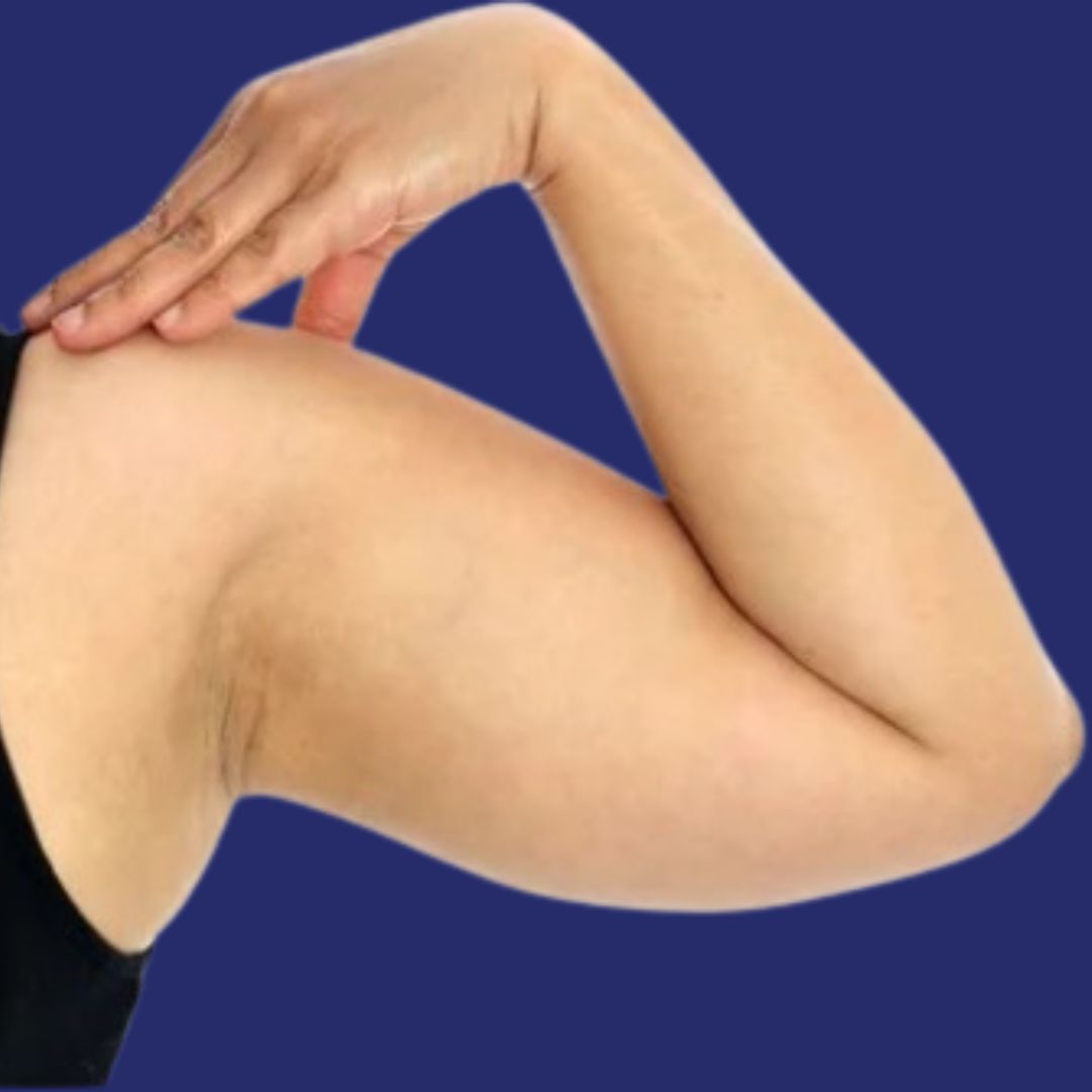 Image of the arm area before the liposuction procedure.