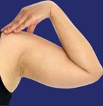 Imagen de la zona de los brazos antes del procedimiento de liposucción.
