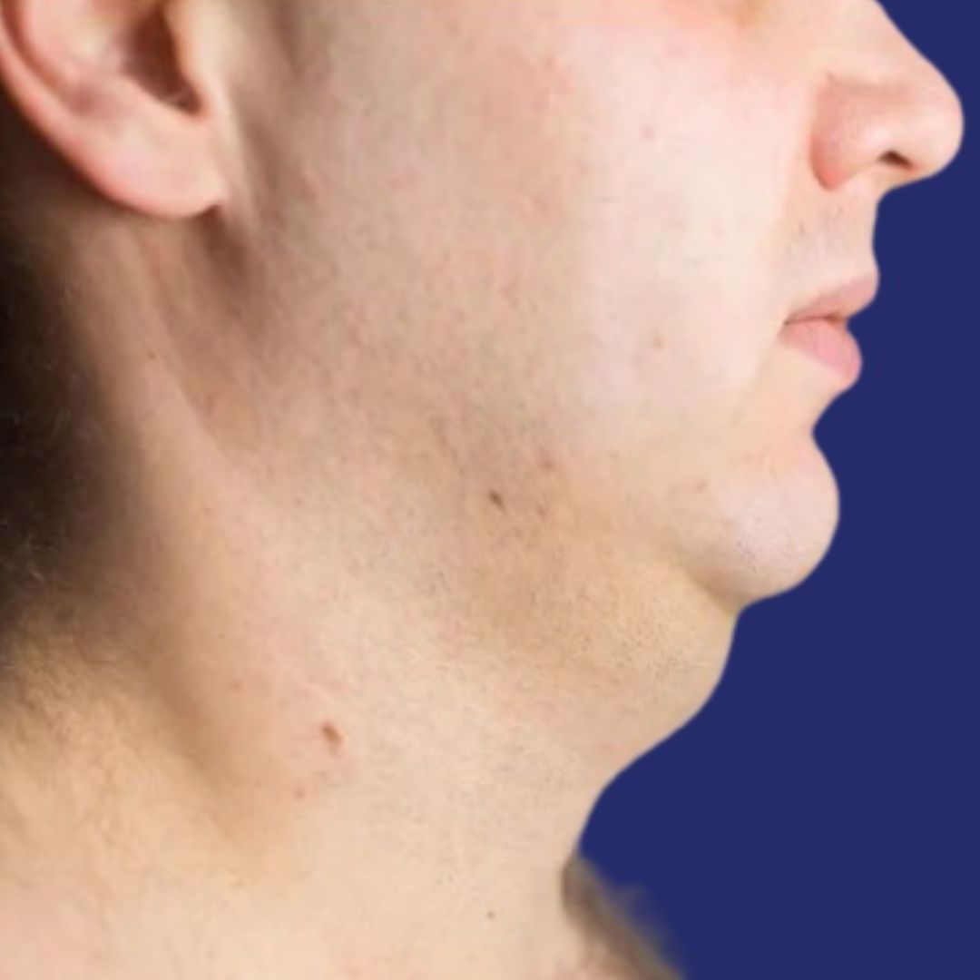 Fotografía del área de la papada tratada antes del procedimiento de liposucción